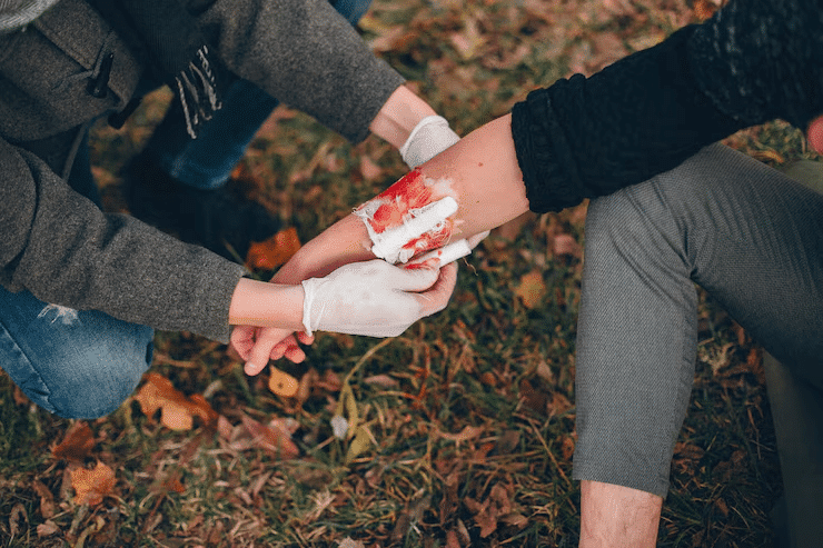 Burn Injuries Caused by South Carolina Car Accidents